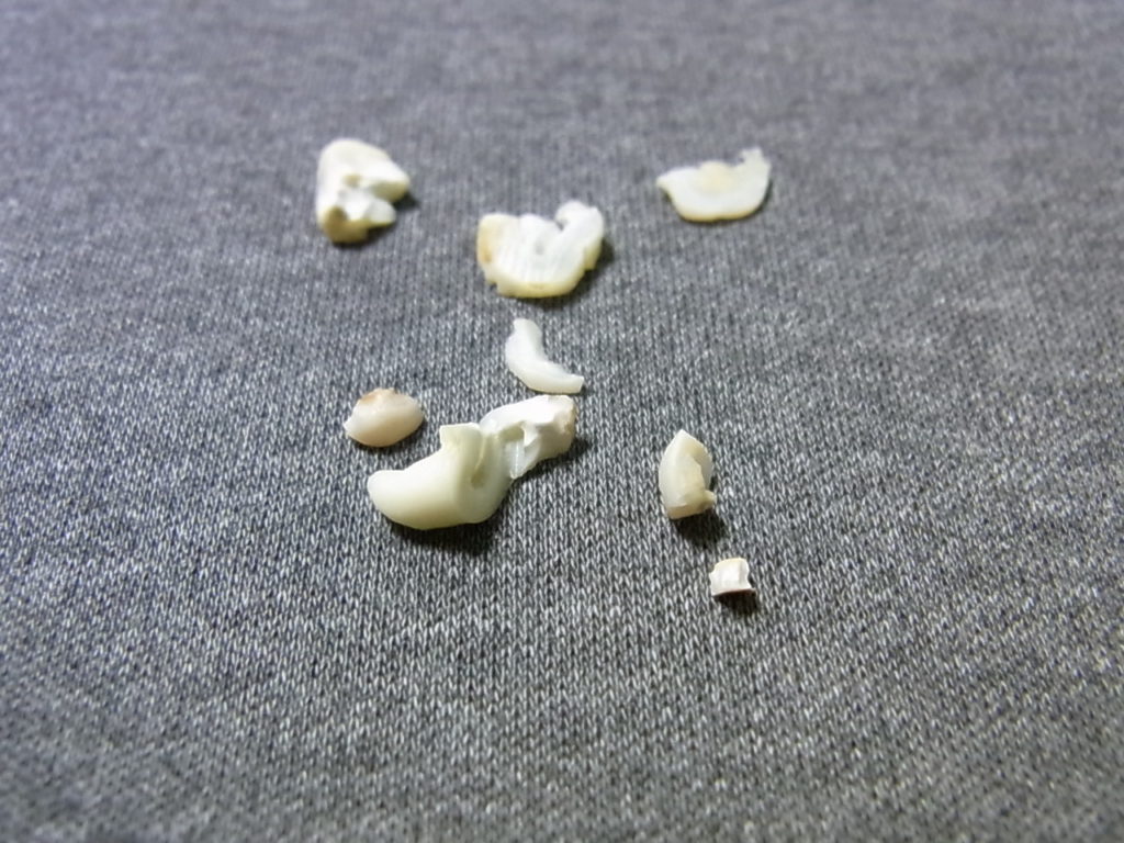自分の親知らずの残骸、あまりにもボロボロすぎる…